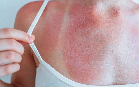 Scottature solari come alleviarle con i rimedi naturali