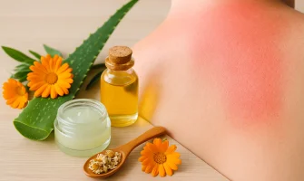 Scottature solari tutti i rimedi naturali