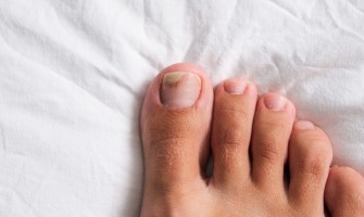 Onicomicosi: come curare la micosi alle unghie con rimedi naturali Onicomicosi: come curare la micosi alle unghie con rimedi naturali