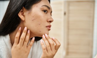 Rimedi naturali per l'acne e la pelle grassa: come curare la pelle dall'interno Rimedi naturali per l'acne e la pelle grassa: come curare la pelle dall'interno
