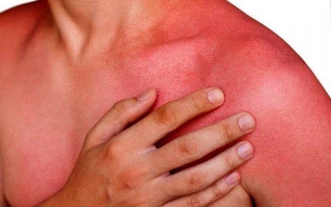 Sunburn All natural remedies